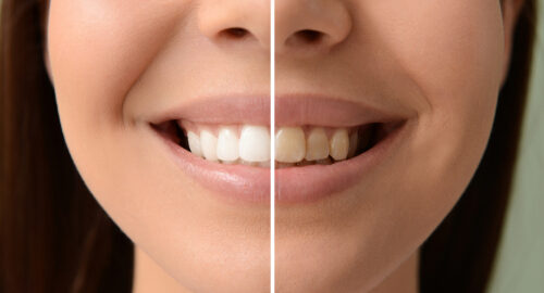 Woman,Before,And,After,Whitening,Of,Her,Teeth,,Closeup Woman,Before,And,After,Whitening,Of,Her,Teeth,,Closeup