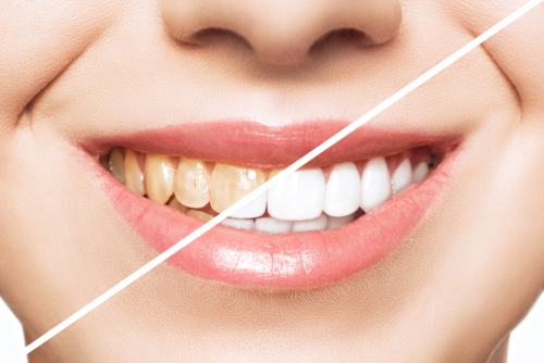 Woman,Teeth,Before,And,After,Whitening.,Over,White,Background.,Dental