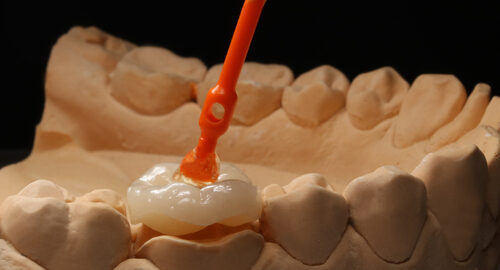 Ceramic,Emax,Crown,On,The,Model