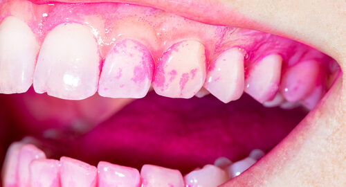 Concept,Of,Deep,And,Detailed,Cleaning,Of,The,Teeth.,Pink Concept,Of,Deep,And,Detailed,Cleaning,Of,The,Teeth.,Pink