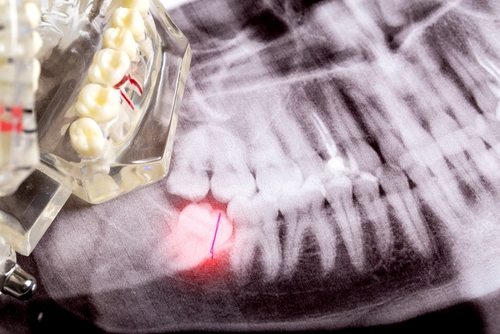 Impacted,Wisdom,Teeth,On,An,X-ray,Picture,With,An,Inflamed