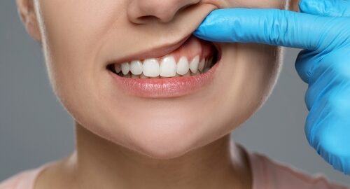 Woman,Showing,Healthy,Gums,On,Gray,Background,,Closeup Woman,Showing,Healthy,Gums,On,Gray,Background,,Closeup