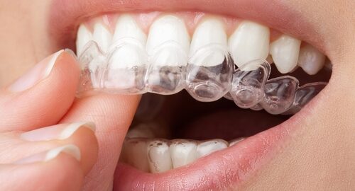 Young,Woman,Holding,Whitening,Tray,With,Gel.,Home,Teeth,Whitening Young,Woman,Holding,Whitening,Tray,With,Gel.,Home,Teeth,Whitening