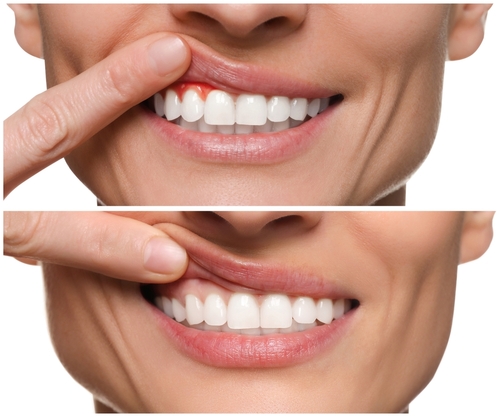 Woman,Showing,Gum,Before,And,After,Treatment,On,White,Background,