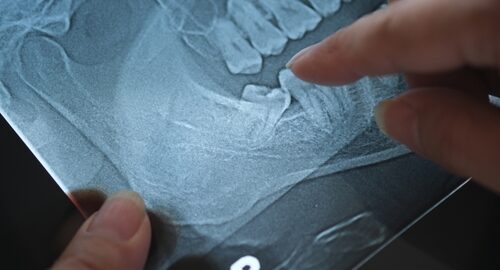 Panoramic,X-ray,Image,Of,Teeth,And,Mouth,With,Wisdom,Teeth Panoramic,X-ray,Image,Of,Teeth,And,Mouth,With,Wisdom,Teeth