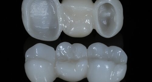 Bridge,Crown,Prosthesis,Treatment,In,Dental,Aesthetic,Dentistry,For,Missing
