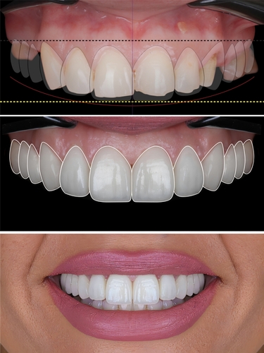 Smile,Design,Treatment,And,Smile,Makeover,With,Porcelain,Laminates,To