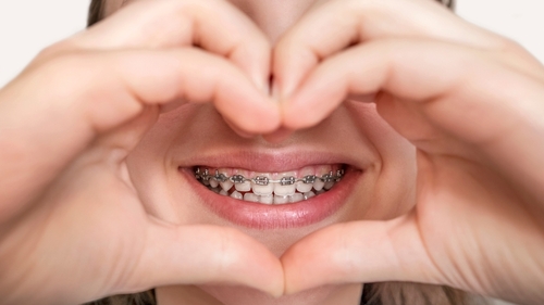 Braces,Teeth,Smile,In,Heart,Hands.,Alignment,Of,Bite,Of