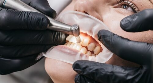 Professional,Teeth,Cleaning,In,A,Modern,Dental,Clinic,,Close-up.,Conceptual Professional,Teeth,Cleaning,In,A,Modern,Dental,Clinic,,Close-up.,Conceptual