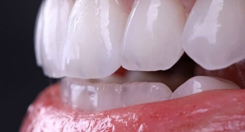 Beautiful,Smile,Of,Young,Woman,With,Perfect,White,Teeth,After