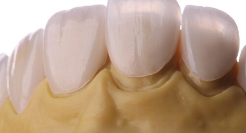 Ceramic,Veneers,Dental,3d,Printing
