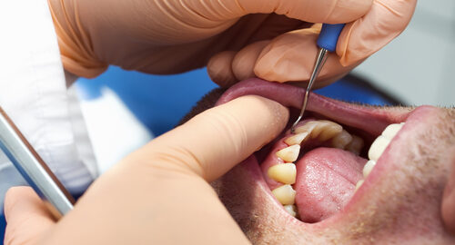 Dentist,Hands,With,Tools,And,Patient,With,Parodontosis,In,A Dentist,Hands,With,Tools,And,Patient,With,Parodontosis,In,A
